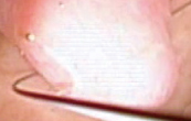 子宮鏡下内膜ポリープ切除術の画像